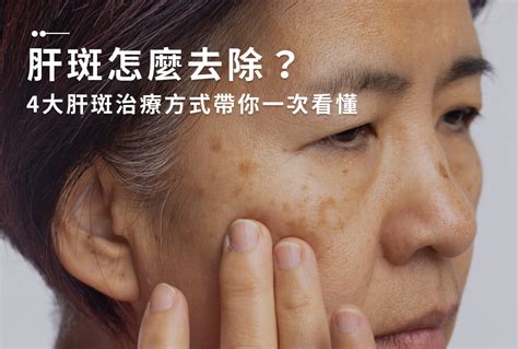 臉部有斑|曬斑、肝斑、長斑怎麼辦？有效淡化斑點5個方法：淡。